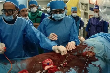 تعویض ۶ دریچه آئورت قلب بدون عمل جراحی با هنر پزشکان گیلانی